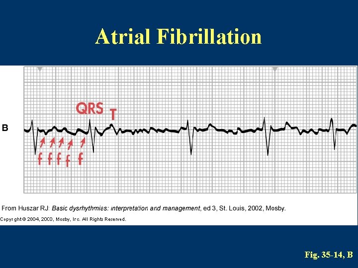 Atrial Fibrillation Fig. 35 -14, B 