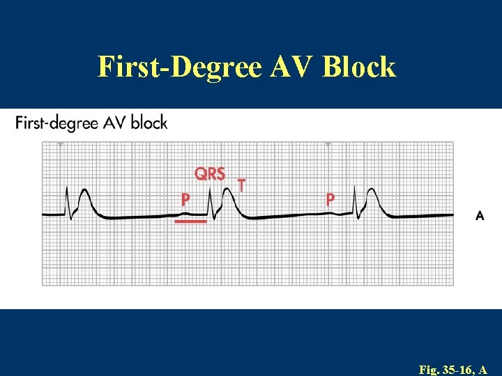 First-Degree AV Block Fig. 35 -16, A 