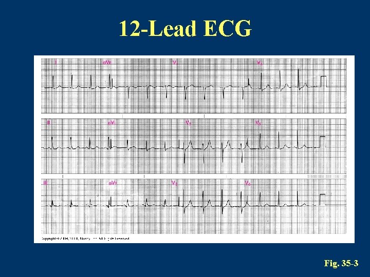 12 -Lead ECG Fig. 35 -3 