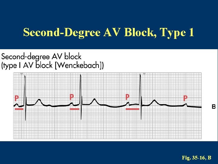 Second-Degree AV Block, Type 1 Fig. 35 -16, B 