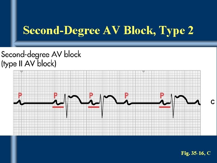Second-Degree AV Block, Type 2 Fig. 35 -16, C 