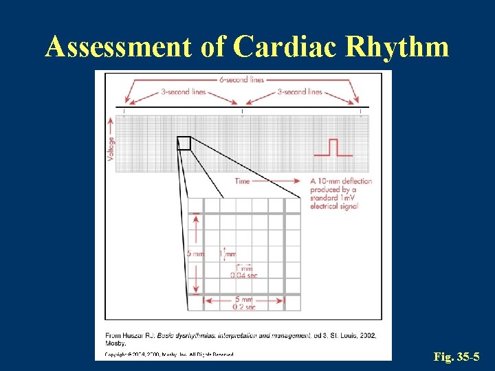 Assessment of Cardiac Rhythm Fig. 35 -5 