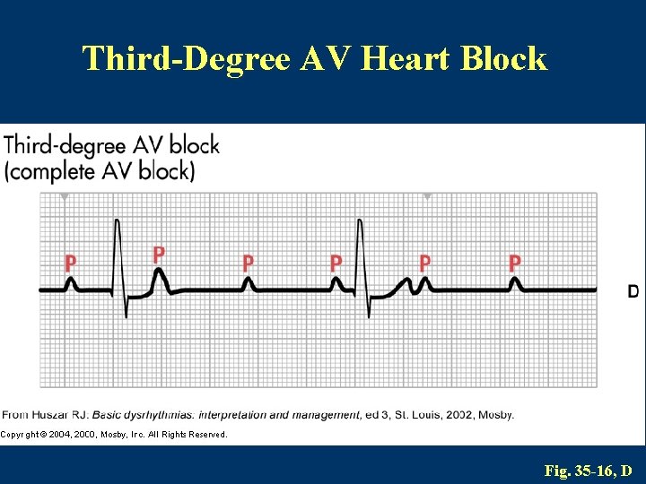 Third-Degree AV Heart Block Fig. 35 -16, D 