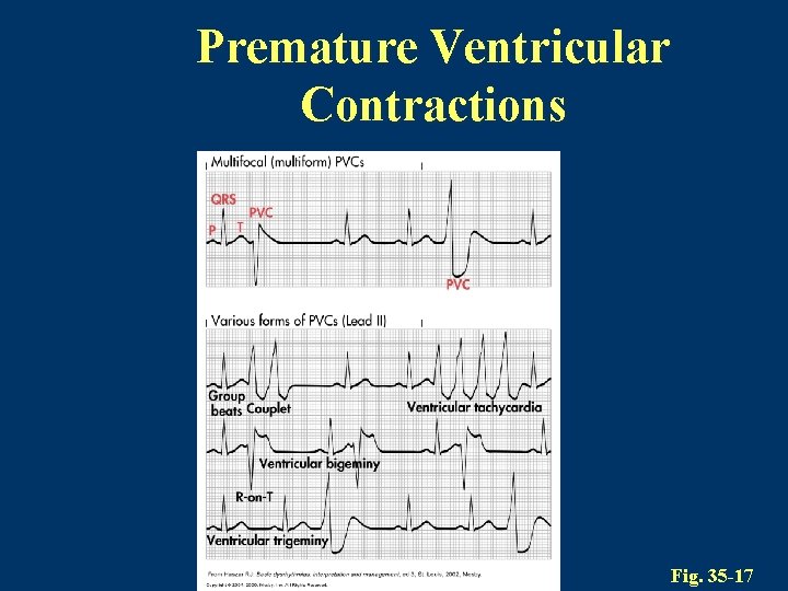 Premature Ventricular Contractions Fig. 35 -17 