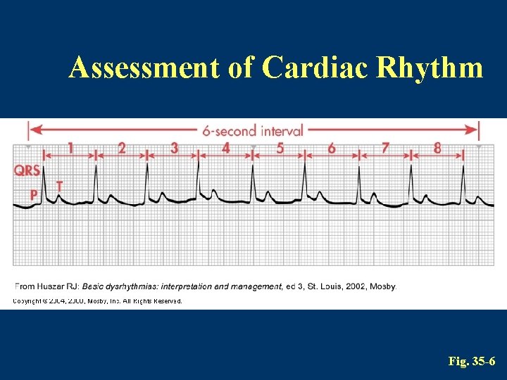 Assessment of Cardiac Rhythm Fig. 35 -6 