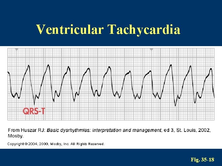 Ventricular Tachycardia Fig. 35 -18 