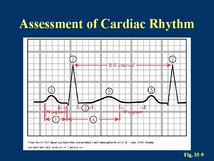 Assessment of Cardiac Rhythm Fig. 35 -9 