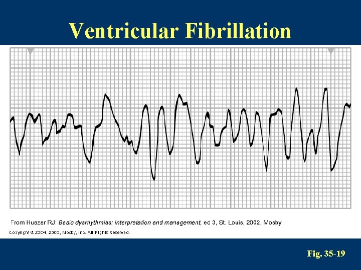 Ventricular Fibrillation Fig. 35 -19 