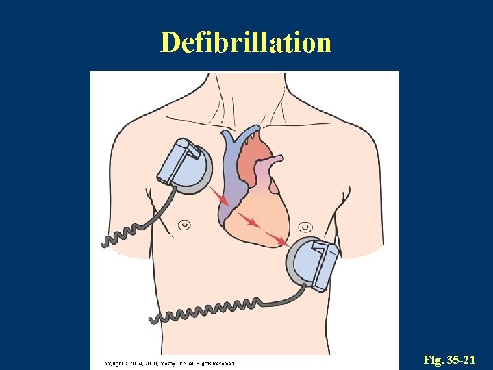 Defibrillation Fig. 35 -21 
