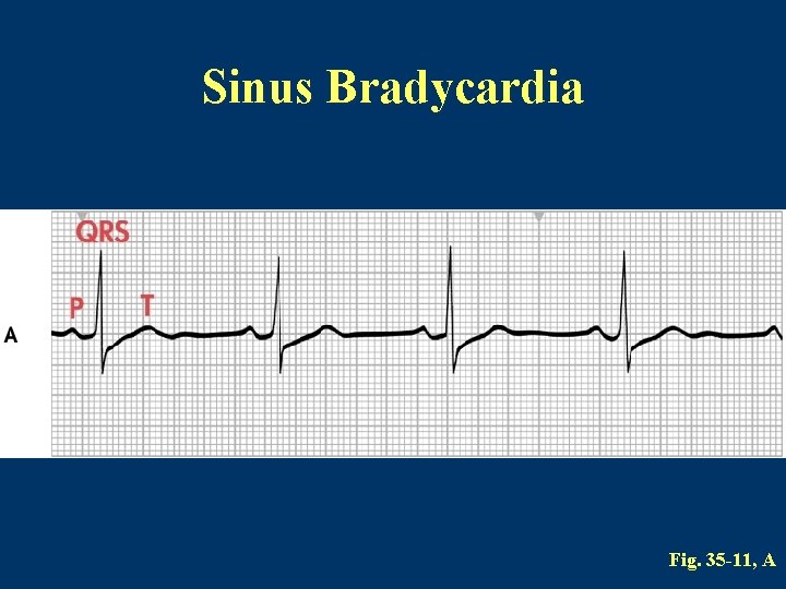 Sinus Bradycardia Fig. 35 -11, A 