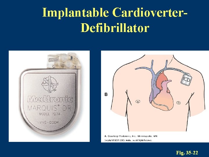 Implantable Cardioverter. Defibrillator Fig. 35 -22 