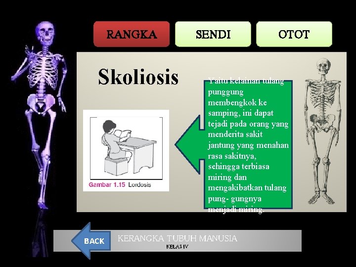 RANGKA SENDI Skoliosis BACK Yaitu kelainan tulang punggung membengkok ke samping, ini dapat tejadi