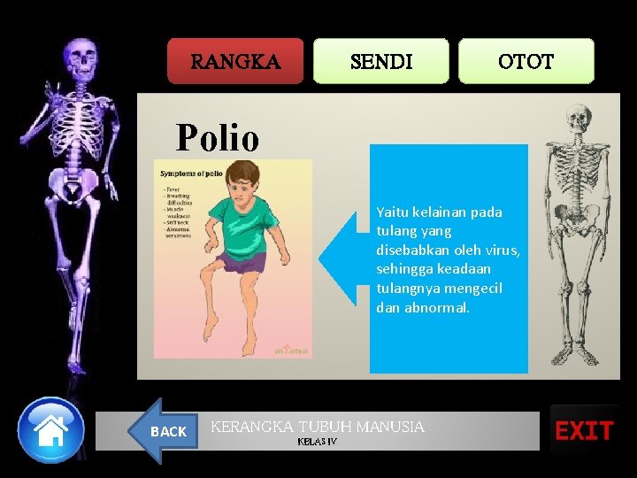 RANGKA SENDI OTOT Polio Yaitu kelainan pada tulang yang disebabkan oleh virus, sehingga keadaan