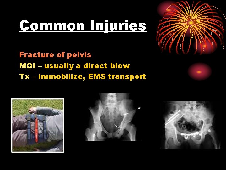 Common Injuries Fracture of pelvis MOI – usually a direct blow Tx – immobilize,