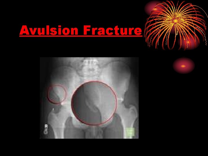 Avulsion Fracture 