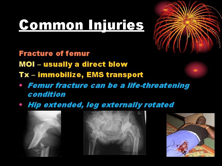 Common Injuries Fracture of femur MOI – usually a direct blow Tx – immobilize,
