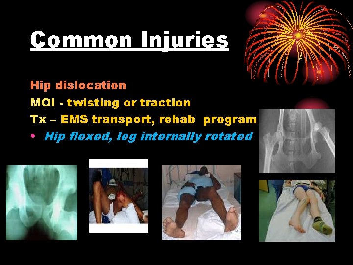Common Injuries Hip dislocation MOI - twisting or traction Tx – EMS transport, rehab
