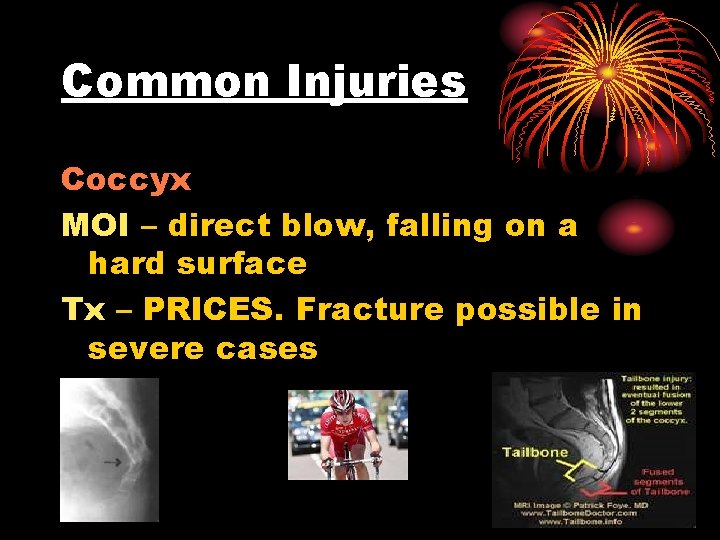 Common Injuries Coccyx MOI – direct blow, falling on a hard surface Tx –