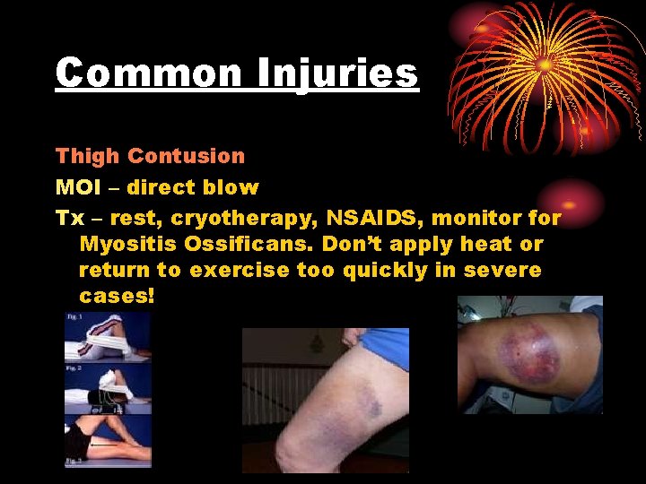 Common Injuries Thigh Contusion MOI – direct blow Tx – rest, cryotherapy, NSAIDS, monitor