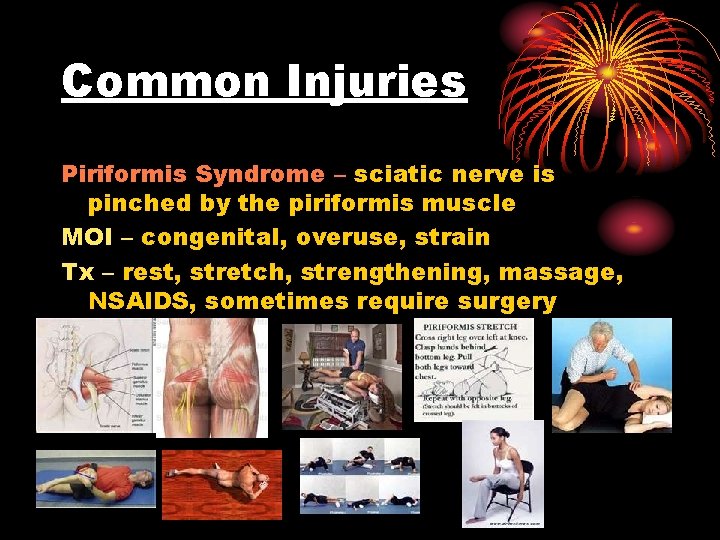 Common Injuries Piriformis Syndrome – sciatic nerve is pinched by the piriformis muscle MOI