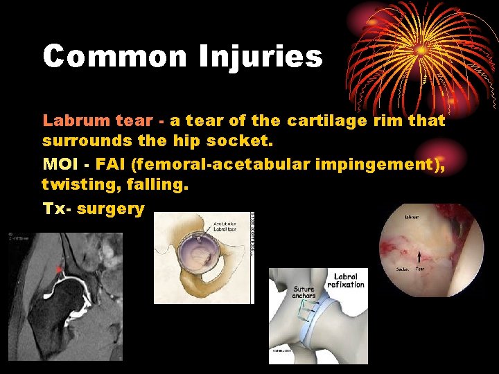 Common Injuries Labrum tear - a tear of the cartilage rim that surrounds the