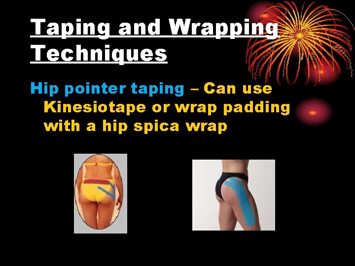 Taping and Wrapping Techniques Hip pointer taping – Can use Kinesiotape or wrap padding