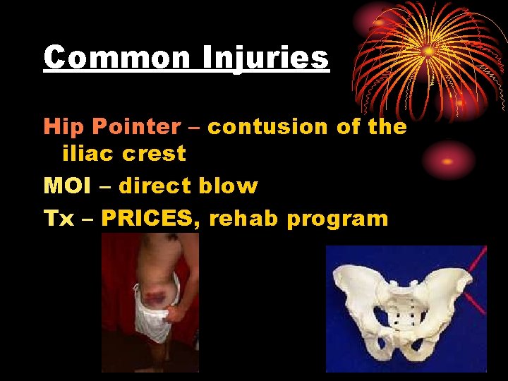 Common Injuries Hip Pointer – contusion of the iliac crest MOI – direct blow