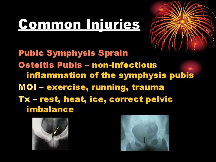 Common Injuries Pubic Symphysis Sprain Osteitis Pubis – non-infectious inflammation of the symphysis pubis