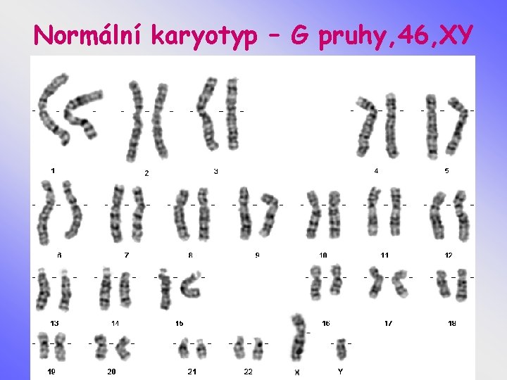 Normální karyotyp – G pruhy, 46, XY 