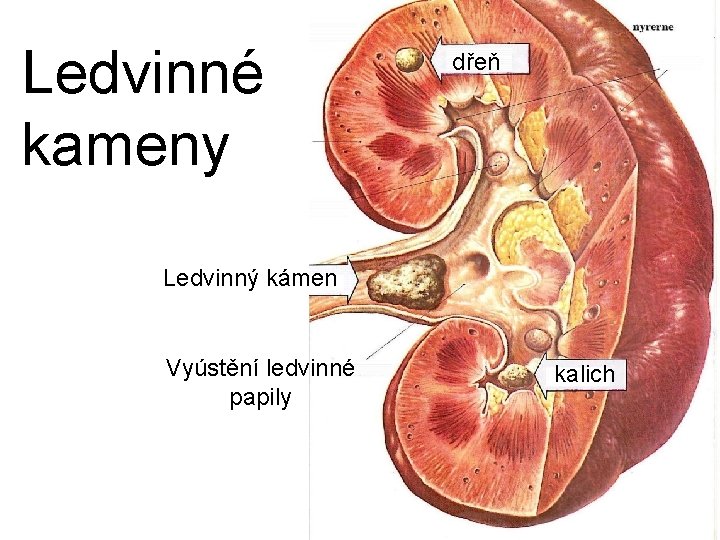 Ledvinné kameny dřeň Ledvinný kámen Vyústění ledvinné papily kalich 