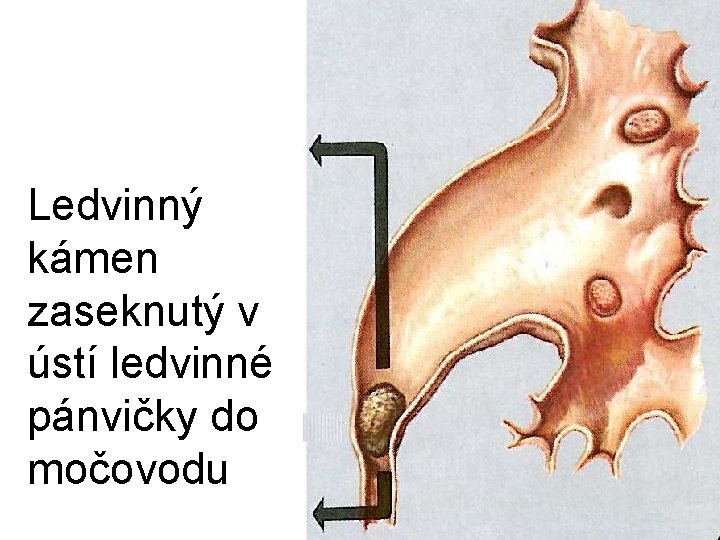 Ledvinný kámen zaseknutý v ústí ledvinné pánvičky do močovodu 