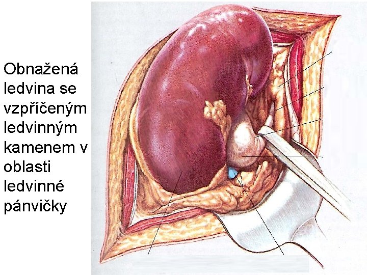 Obnažená ledvina se vzpříčeným ledvinným kamenem v oblasti ledvinné pánvičky 
