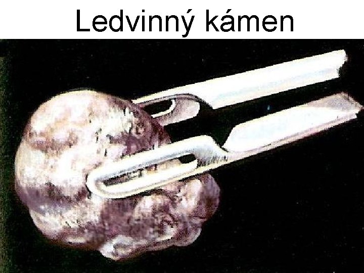 Ledvinný kámen 