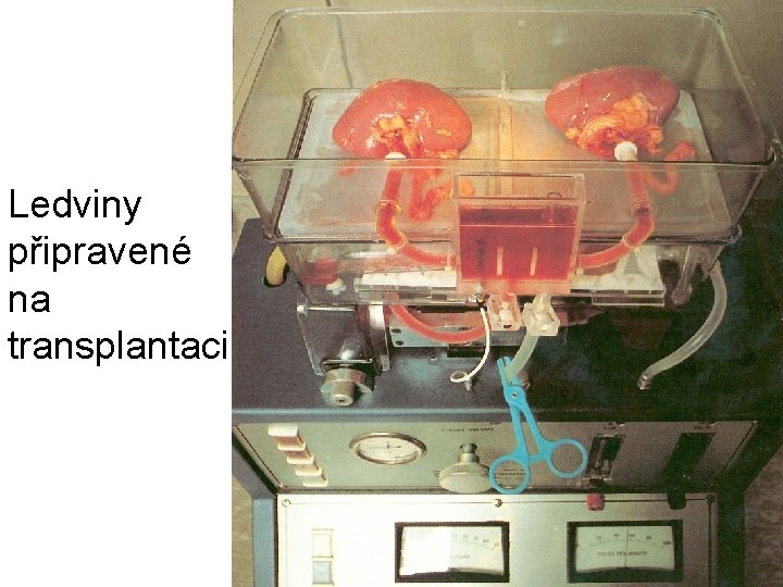 Ledviny připravené na transplantaci 