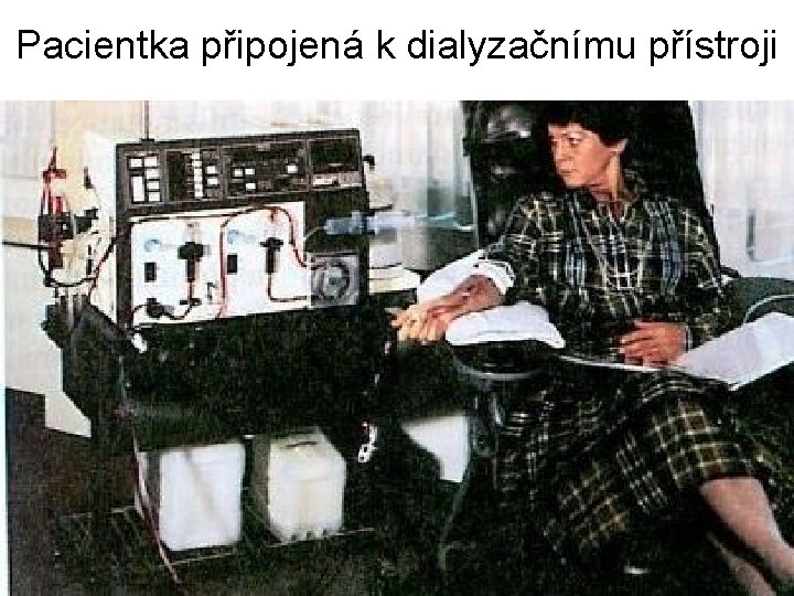 Pacientka připojená k dialyzačnímu přístroji 