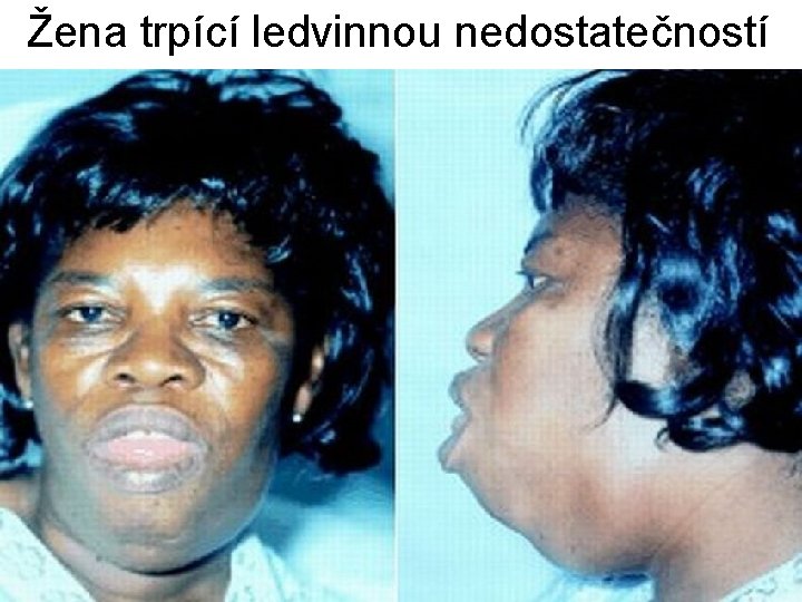 Žena trpící ledvinnou nedostatečností 