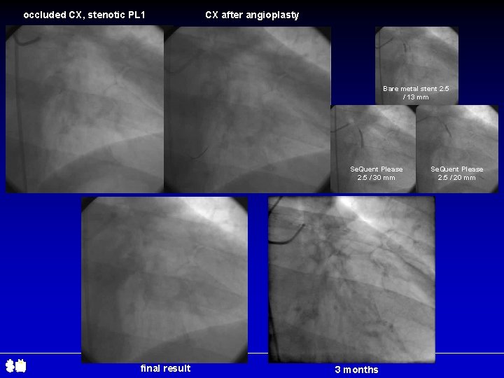 occluded CX, stenotic PL 1 CX after angioplasty dissection Bare metal stent 2. 5