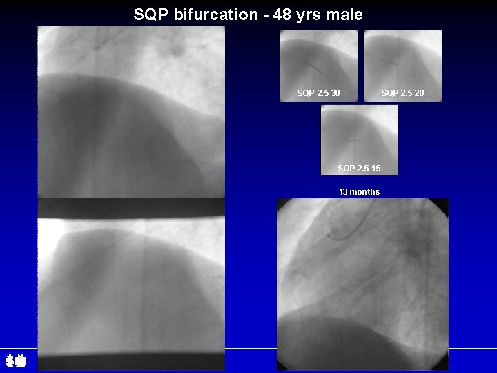 SQP bifurcation - 48 yrs male SQP 2. 5 30 SQP 2. 5 15