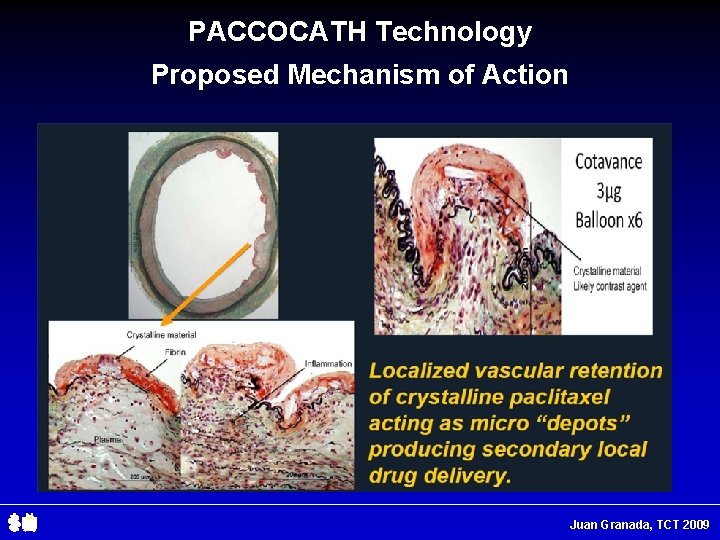 PACCOCATH Technology Proposed Mechanism of Action Juan Granada, TCT 2009 