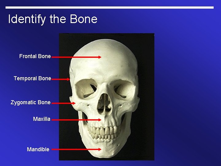 Identify the Bone Frontal Bone Temporal Bone Zygomatic Bone Maxilla Mandible 