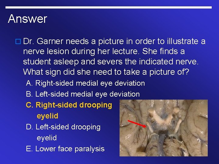 Answer o Dr. Garner needs a picture in order to illustrate a nerve lesion