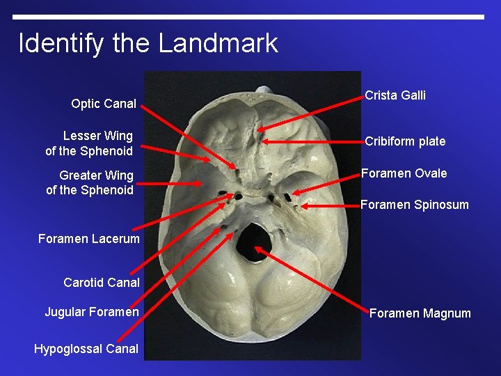 Identify the Landmark Optic Canal Crista Galli Lesser Wing of the Sphenoid Cribiform plate