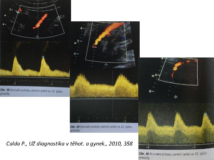 Calda P. , UZ diagnostika v těhot. a gynek. , 2010, 358 