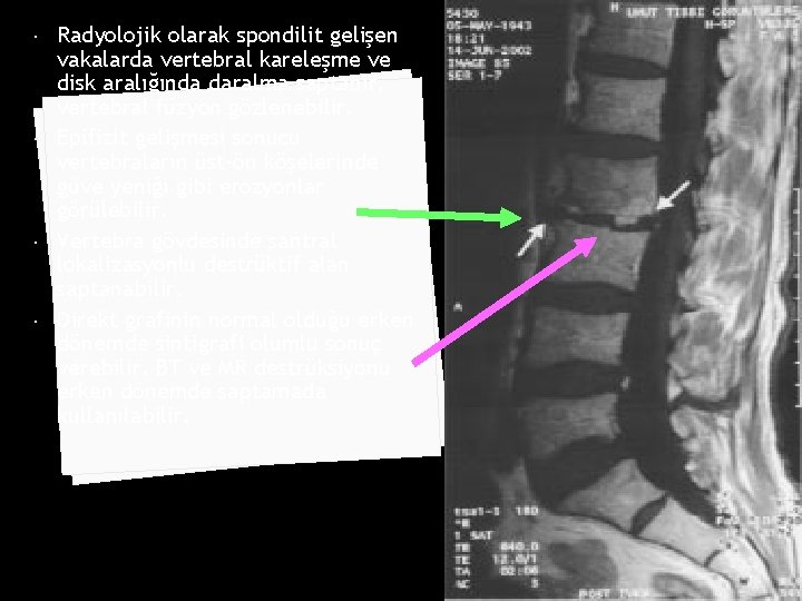  Radyolojik olarak spondilit gelişen vakalarda vertebral kareleşme ve disk aralığında daralma saptanır, vertebral