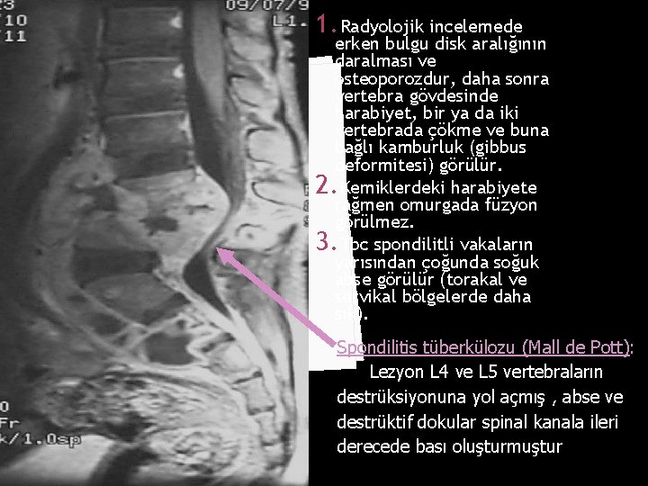 1. Radyolojik incelemede erken bulgu disk aralığının daralması ve osteoporozdur, daha sonra vertebra gövdesinde