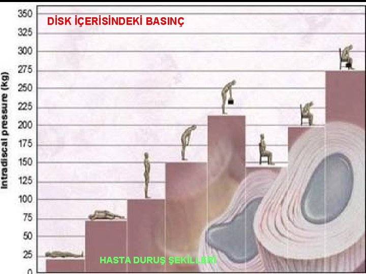 DİSK İÇERİSİNDEKİ BASINÇ HASTA DURUŞ ŞEKİLLERİ 