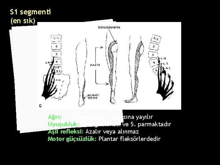 S 1 segmenti (en sık) Ağrı: Uyluk ve bacağın arkasına yayılır Uyuşukluk: Bacağın arkası