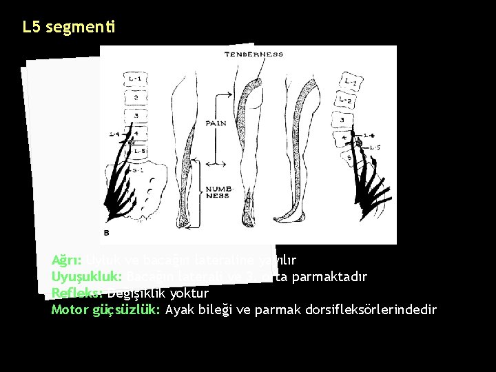 L 5 segmenti Ağrı: Uyluk ve bacağın lateraline yayılır Uyuşukluk: Bacağın laterali ve 3.