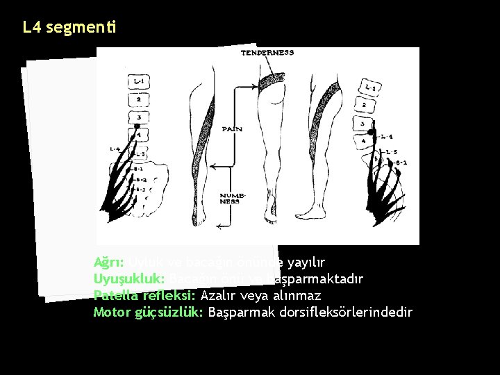 L 4 segmenti Ağrı: Uyluk ve bacağın önünde yayılır Uyuşukluk: Bacağın önü ve başparmaktadır