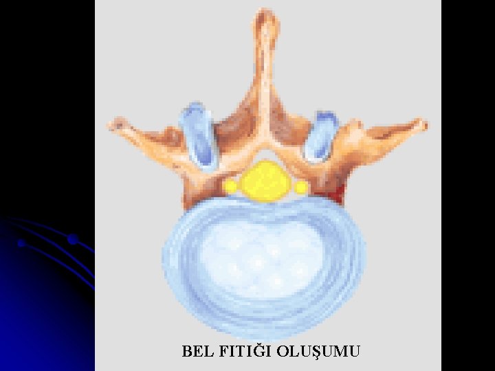 BEL FITIĞI OLUŞUMU 